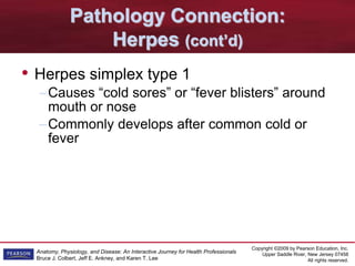Copyright ©2009 by Pearson Education, Inc.
Upper Saddle River, New Jersey 07458
All rights reserved.
Anatomy, Physiology, and Disease: An Interactive Journey for Health Professionals
Bruce J. Colbert, Jeff E. Ankney, and Karen T. Lee
Pathology Connection:
Herpes (cont’d)
• Herpes simplex type 1
–Causes “cold sores” or “fever blisters” around
mouth or nose
–Commonly develops after common cold or
fever
 