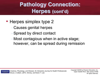Copyright ©2009 by Pearson Education, Inc.
Upper Saddle River, New Jersey 07458
All rights reserved.
Anatomy, Physiology, and Disease: An Interactive Journey for Health Professionals
Bruce J. Colbert, Jeff E. Ankney, and Karen T. Lee
Pathology Connection:
Herpes (cont’d)
• Herpes simplex type 2
–Causes genital herpes
–Spread by direct contact
–Most contagious when in active stage;
however, can be spread during remission
 