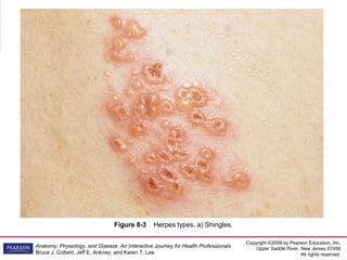Copyright ©2009 by Pearson Education, Inc.
Upper Saddle River, New Jersey 07458
All rights reserved.
Anatomy, Physiology, and Disease: An Interactive Journey for Health Professionals
Bruce J. Colbert, Jeff E. Ankney, and Karen T. Lee
Figure 8-3 Herpes types. a) Shingles.
 