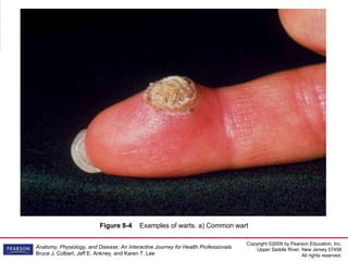 Copyright ©2009 by Pearson Education, Inc.
Upper Saddle River, New Jersey 07458
All rights reserved.
Anatomy, Physiology, and Disease: An Interactive Journey for Health Professionals
Bruce J. Colbert, Jeff E. Ankney, and Karen T. Lee
Figure 8-4 Examples of warts. a) Common wart
 