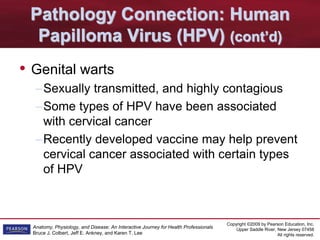 Copyright ©2009 by Pearson Education, Inc.
Upper Saddle River, New Jersey 07458
All rights reserved.
Anatomy, Physiology, and Disease: An Interactive Journey for Health Professionals
Bruce J. Colbert, Jeff E. Ankney, and Karen T. Lee
Pathology Connection: Human
Papilloma Virus (HPV) (cont’d)
• Genital warts
–Sexually transmitted, and highly contagious
–Some types of HPV have been associated
with cervical cancer
–Recently developed vaccine may help prevent
cervical cancer associated with certain types
of HPV
 