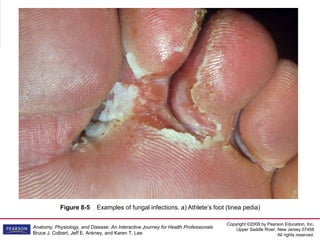 Copyright ©2009 by Pearson Education, Inc.
Upper Saddle River, New Jersey 07458
All rights reserved.
Anatomy, Physiology, and Disease: An Interactive Journey for Health Professionals
Bruce J. Colbert, Jeff E. Ankney, and Karen T. Lee
Figure 8-5 Examples of fungal infections. a) Athlete’s foot (tinea pedia)
 