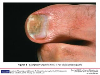Copyright ©2009 by Pearson Education, Inc.
Upper Saddle River, New Jersey 07458
All rights reserved.
Anatomy, Physiology, and Disease: An Interactive Journey for Health Professionals
Bruce J. Colbert, Jeff E. Ankney, and Karen T. Lee
Figure 8-5 Examples of fungal infections. b) Nail fungus (tinea unguium).
 