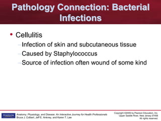 Copyright ©2009 by Pearson Education, Inc.
Upper Saddle River, New Jersey 07458
All rights reserved.
Anatomy, Physiology, and Disease: An Interactive Journey for Health Professionals
Bruce J. Colbert, Jeff E. Ankney, and Karen T. Lee
Pathology Connection: Bacterial
Infections
• Cellulitis
–Infection of skin and subcutaneous tissue
–Caused by Staphylococcus
–Source of infection often wound of some kind
 