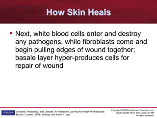 Copyright ©2009 by Pearson Education, Inc.
Upper Saddle River, New Jersey 07458
All rights reserved.
Anatomy, Physiology, and Disease: An Interactive Journey for Health Professionals
Bruce J. Colbert, Jeff E. Ankney, and Karen T. Lee
How Skin Heals
• Next, white blood cells enter and destroy
any pathogens, while fibroblasts come and
begin pulling edges of wound together;
basale layer hyper-produces cells for
repair of wound
 