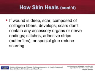Copyright ©2009 by Pearson Education, Inc.
Upper Saddle River, New Jersey 07458
All rights reserved.
Anatomy, Physiology, and Disease: An Interactive Journey for Health Professionals
Bruce J. Colbert, Jeff E. Ankney, and Karen T. Lee
How Skin Heals (cont’d)
• If wound is deep, scar, composed of
collagen fibers, develops; scars don’t
contain any accessory organs or nerve
endings; stitches, adhesive strips
(butterflies), or special glue reduce
scarring
 
