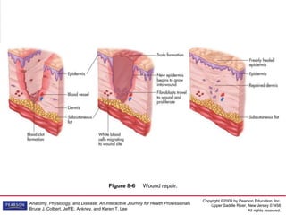 Copyright ©2009 by Pearson Education, Inc.
Upper Saddle River, New Jersey 07458
All rights reserved.
Anatomy, Physiology, and Disease: An Interactive Journey for Health Professionals
Bruce J. Colbert, Jeff E. Ankney, and Karen T. Lee
Figure 8-6 Wound repair.
 