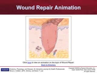 Copyright ©2009 by Pearson Education, Inc.
Upper Saddle River, New Jersey 07458
All rights reserved.
Anatomy, Physiology, and Disease: An Interactive Journey for Health Professionals
Bruce J. Colbert, Jeff E. Ankney, and Karen T. Lee
Click here to view an animation on the topic of Wound Repair.
Wound Repair Animation
Back to Directory
 
