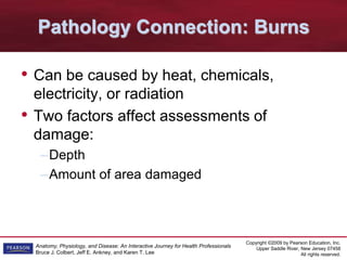 Copyright ©2009 by Pearson Education, Inc.
Upper Saddle River, New Jersey 07458
All rights reserved.
Anatomy, Physiology, and Disease: An Interactive Journey for Health Professionals
Bruce J. Colbert, Jeff E. Ankney, and Karen T. Lee
Pathology Connection: Burns
• Can be caused by heat, chemicals,
electricity, or radiation
• Two factors affect assessments of
damage:
–Depth
–Amount of area damaged
 