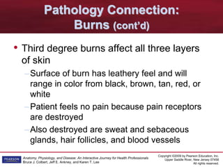 Copyright ©2009 by Pearson Education, Inc.
Upper Saddle River, New Jersey 07458
All rights reserved.
Anatomy, Physiology, and Disease: An Interactive Journey for Health Professionals
Bruce J. Colbert, Jeff E. Ankney, and Karen T. Lee
Pathology Connection:
Burns (cont’d)
• Third degree burns affect all three layers
of skin
–Surface of burn has leathery feel and will
range in color from black, brown, tan, red, or
white
–Patient feels no pain because pain receptors
are destroyed
–Also destroyed are sweat and sebaceous
glands, hair follicles, and blood vessels
 
