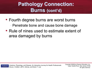 Copyright ©2009 by Pearson Education, Inc.
Upper Saddle River, New Jersey 07458
All rights reserved.
Anatomy, Physiology, and Disease: An Interactive Journey for Health Professionals
Bruce J. Colbert, Jeff E. Ankney, and Karen T. Lee
Pathology Connection:
Burns (cont’d)
• Fourth degree burns are worst burns
–Penetrate bone and cause bone damage
• Rule of nines used to estimate extent of
area damaged by burns
 