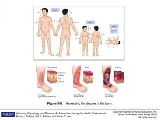 Copyright ©2009 by Pearson Education, Inc.
Upper Saddle River, New Jersey 07458
All rights reserved.
Anatomy, Physiology, and Disease: An Interactive Journey for Health Professionals
Bruce J. Colbert, Jeff E. Ankney, and Karen T. Lee
Figure 8-8 Assessing the degree of the burn.
 