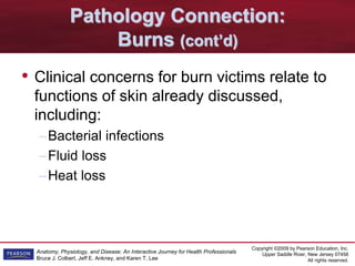 Copyright ©2009 by Pearson Education, Inc.
Upper Saddle River, New Jersey 07458
All rights reserved.
Anatomy, Physiology, and Disease: An Interactive Journey for Health Professionals
Bruce J. Colbert, Jeff E. Ankney, and Karen T. Lee
Pathology Connection:
Burns (cont’d)
• Clinical concerns for burn victims relate to
functions of skin already discussed,
including:
–Bacterial infections
–Fluid loss
–Heat loss
 