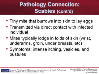 Copyright ©2009 by Pearson Education, Inc.
Upper Saddle River, New Jersey 07458
All rights reserved.
Anatomy, Physiology, and Disease: An Interactive Journey for Health Professionals
Bruce J. Colbert, Jeff E. Ankney, and Karen T. Lee
Pathology Connection:
Scabies (cont’d)
• Tiny mite that burrows into skin to lay eggs
• Transmitted via direct contact with infected
individual
• Mites typically lodge in folds of skin (wrist,
underarms, groin, under breasts, etc)
• Symptoms: intense itching, vesicles, and
pustules
 