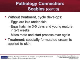 Copyright ©2009 by Pearson Education, Inc.
Upper Saddle River, New Jersey 07458
All rights reserved.
Anatomy, Physiology, and Disease: An Interactive Journey for Health Professionals
Bruce J. Colbert, Jeff E. Ankney, and Karen T. Lee
Pathology Connection:
Scabies (cont’d)
• Without treatment, cycle develops:
–Eggs are laid under skin
–Eggs hatch in 3-5 days and young mature
in 2-3 weeks
–Mites mate and start process over again
• Treatment: specially formulated cream is
applied to skin
 