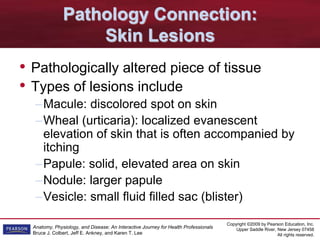 Copyright ©2009 by Pearson Education, Inc.
Upper Saddle River, New Jersey 07458
All rights reserved.
Anatomy, Physiology, and Disease: An Interactive Journey for Health Professionals
Bruce J. Colbert, Jeff E. Ankney, and Karen T. Lee
Pathology Connection:
Skin Lesions
• Pathologically altered piece of tissue
• Types of lesions include
–Macule: discolored spot on skin
–Wheal (urticaria): localized evanescent
elevation of skin that is often accompanied by
itching
–Papule: solid, elevated area on skin
–Nodule: larger papule
–Vesicle: small fluid filled sac (blister)
 