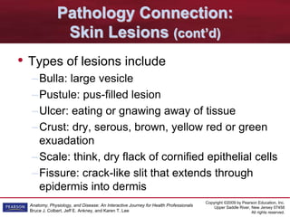 Copyright ©2009 by Pearson Education, Inc.
Upper Saddle River, New Jersey 07458
All rights reserved.
Anatomy, Physiology, and Disease: An Interactive Journey for Health Professionals
Bruce J. Colbert, Jeff E. Ankney, and Karen T. Lee
Pathology Connection:
Skin Lesions (cont’d)
• Types of lesions include
–Bulla: large vesicle
–Pustule: pus-filled lesion
–Ulcer: eating or gnawing away of tissue
–Crust: dry, serous, brown, yellow red or green
exuadation
–Scale: think, dry flack of cornified epithelial cells
–Fissure: crack-like slit that extends through
epidermis into dermis
 