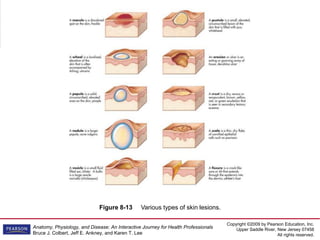 Copyright ©2009 by Pearson Education, Inc.
Upper Saddle River, New Jersey 07458
All rights reserved.
Anatomy, Physiology, and Disease: An Interactive Journey for Health Professionals
Bruce J. Colbert, Jeff E. Ankney, and Karen T. Lee
Figure 8-13 Various types of skin lesions.
 