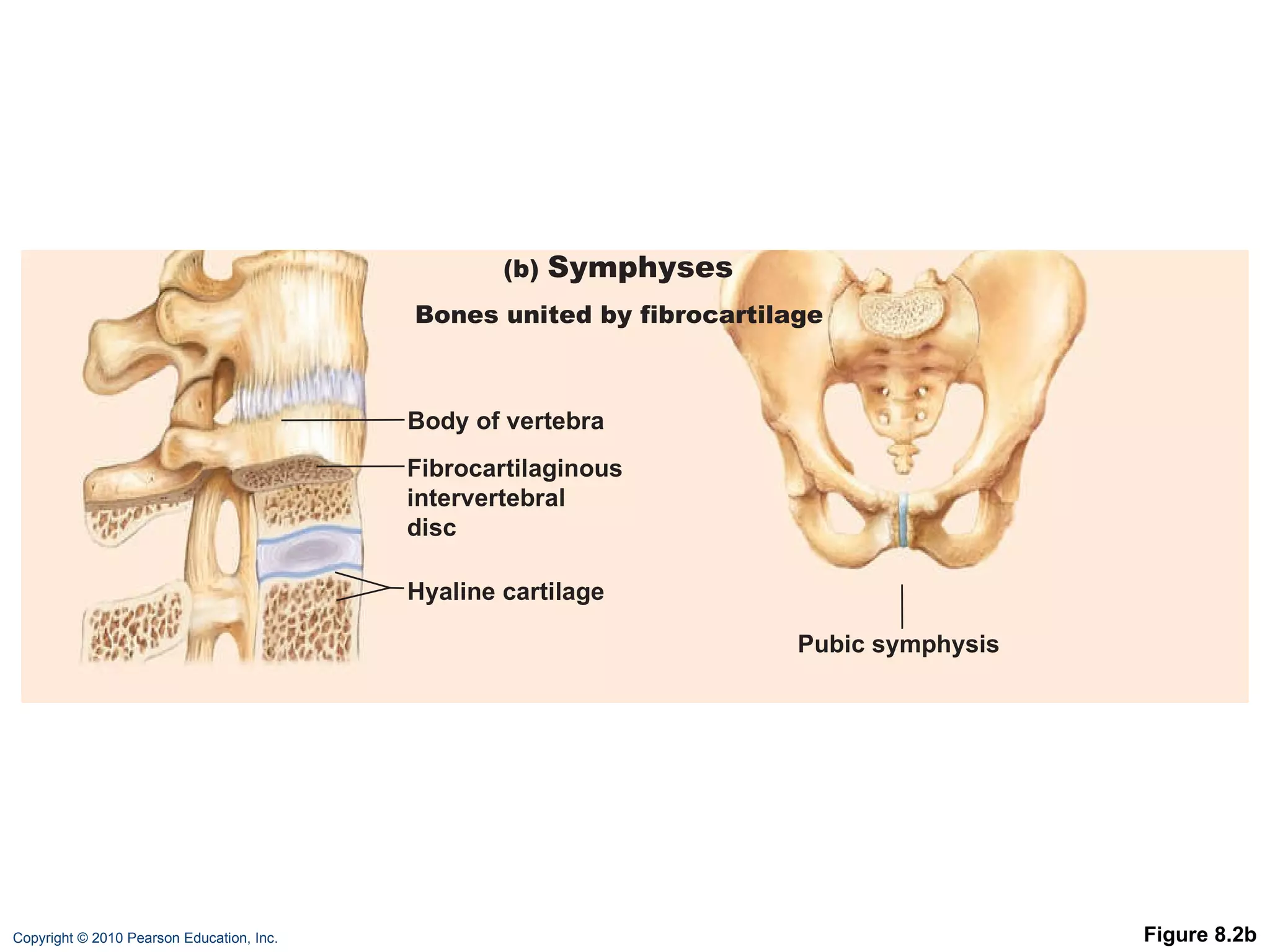 Figure 8.2b Fibrocartilaginous intervertebral disc Pubic symphysis Body of vertebra Hyaline cartilage (b)  Symphyses Bones united by fibrocartilage 