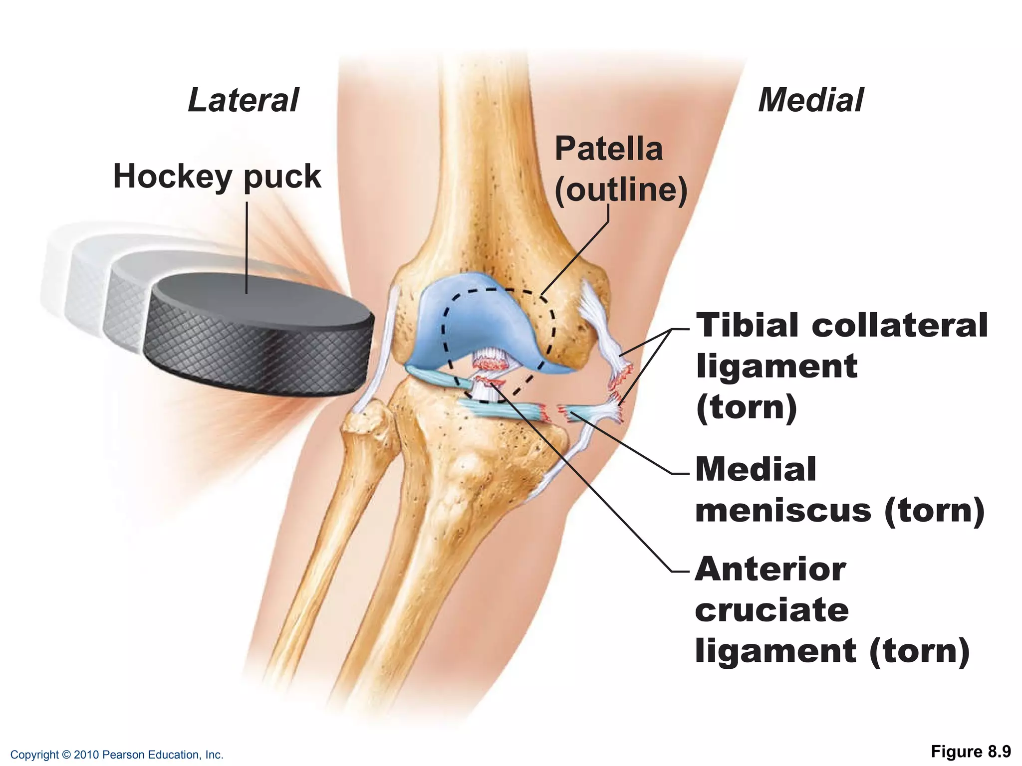 Figure 8.9 Lateral Medial Patella (outline) Tibial collateral ligament (torn) Medial meniscus (torn) Anterior cruciate ligament (torn) Hockey puck 