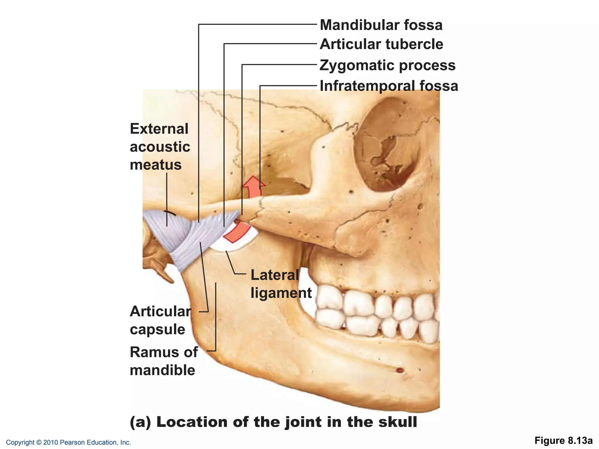 Figure 8.13a Zygomatic process Mandibular fossa Articular tubercle Infratemporal fossa External acoustic meatus Articular capsule Ramus of mandible  Lateral ligament  (a) Location of the joint in the skull 