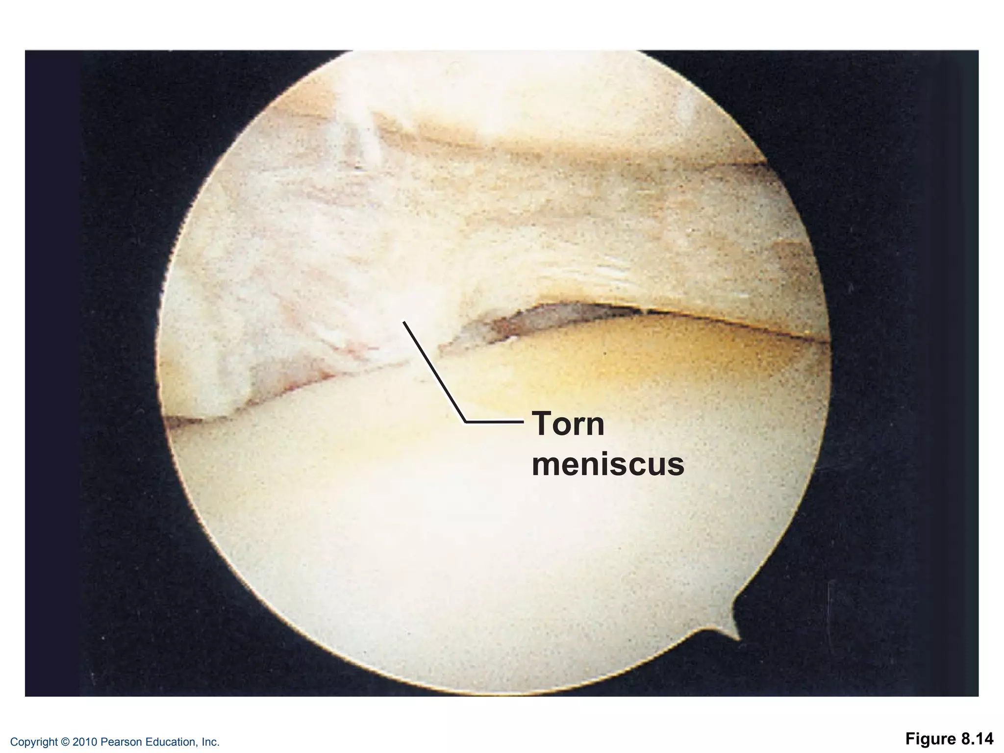Figure 8.14 Torn meniscus 