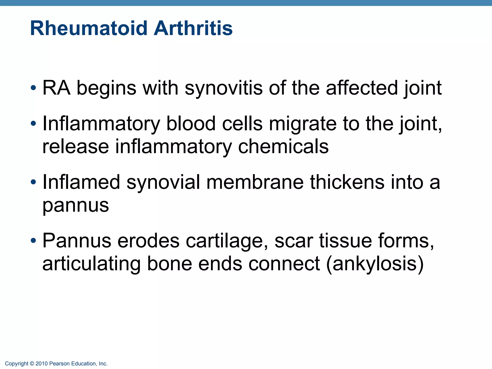 Rheumatoid Arthritis  RA begins with synovitis of the affected joint Inflammatory blood cells migrate to the joint, release inflammatory chemicals  Inflamed synovial membrane thickens into a pannus Pannus erodes cartilage, scar tissue forms, articulating bone ends connect (ankylosis) 