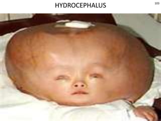 © 2019 McGraw-Hill Education
103
HYDROCEPHALUS
 