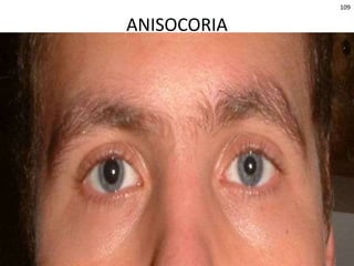 © 2019 McGraw-Hill Education
109
ANISOCORIA
 