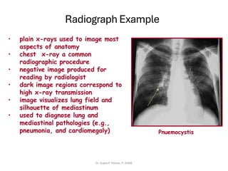 Radiograph Example
• plain x-rays used to image most
aspects of anatomy
• chest x-ray a common
radiographic procedure
• negative image produced for
reading by radiologist
• dark image regions correspond to
high x-ray transmission
• image visualizes lung field and
silhouette of mediastinum
• used to diagnose lung and
mediastinal pathologies (e.g.,
pneumonia, and cardiomegaly) Pnuemocystis
Dr. Sujata P. Pathak, IT, KJSSE
 