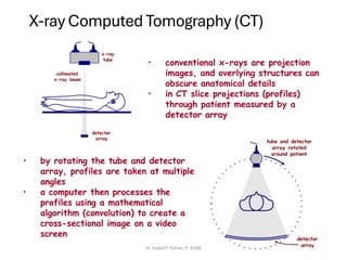 X-ray Computed Tomography (CT)
x-ray
tube
collimated
x-ray beam
detector
array
• conventional x-rays are projection
images, and overlying structures can
obscure anatomical details
• in CT slice projections (profiles)
through patient measured by a
detector array
tube and detector
array rotated
around patient
detector
array
• by rotating the tube and detector
array, profiles are taken at multiple
angles
• a computer then processes the
profiles using a mathematical
algorithm (convolution) to create a
cross-sectional image on a video
screen
Dr. Sujata P. Pathak, IT, KJSSE
 