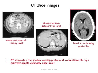 • CT eliminates the shadow overlap problem of conventional X-rays
• contrast agents commonly used in CT
CT Slice Images
abdominal scan
spleen/liver level
abdominal scan at
kidney level head scan showing
ventricles
Dr. Sujata P. Pathak, IT, KJSSE
 