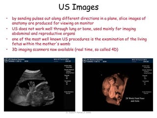 US Images
• by sending pulses out along different directions in a plane, slice images of
anatomy are produced for viewing on monitor
• US does not work well through lung or bone, used mainly for imaging
abdominal and reproductive organs
• one of the most well known US procedures is the examination of the living
fetus within the mother's womb
• 3D imaging scanners now available (real time, so called 4D)
Dr. Sujata P. Pathak, IT, KJSSE
 