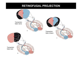 RETINOFUGAL PROJECTION




              Transection
              Optic nerve




                                     Transection
                                     Optic chiasm




Transection
Optic tract
 