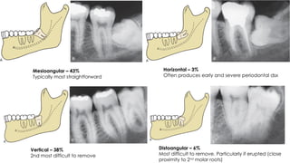 Principles of Management of Impacted Teeth_Mari-Alina_Timoshchuk.pptx