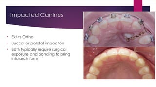 Principles of Management of Impacted Teeth_Mari-Alina_Timoshchuk.pptx