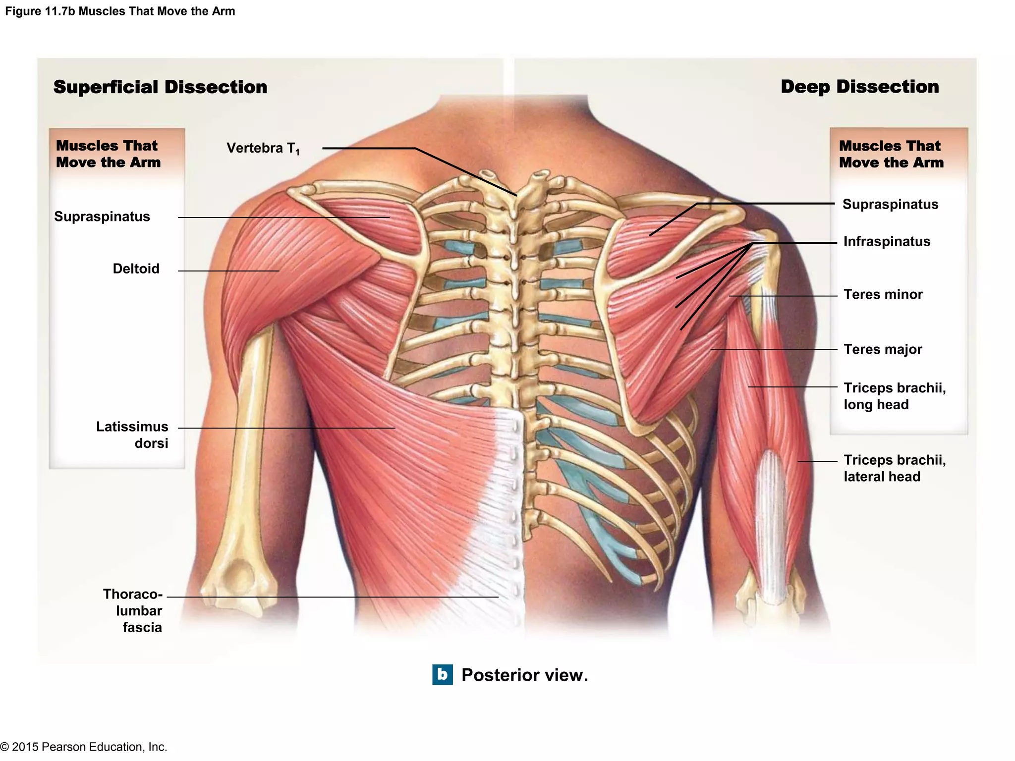 © 2015 Pearson Education, Inc.
Figure 11.7b Muscles That Move the Arm
Superficial Dissection Deep Dissection
Muscles That
Move the Arm
Muscles That
Move the Arm
b Posterior view.
Triceps brachii,
lateral head
Triceps brachii,
long head
Teres major
Teres minor
Infraspinatus
Supraspinatus
Vertebra T1
Supraspinatus
Deltoid
Latissimus
dorsi
Thoraco-
lumbar
fascia
 