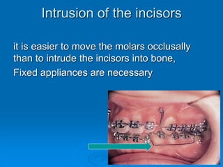 Intrusion of the incisors
it is easier to move the molars occlusally
than to intrude the incisors into bone,
Fixed appliances are necessary
 