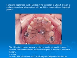Fig. 10.20 An upper removable appliance used to expand the upper
arch and procline retroclined upper incisors prior to functional appliance
therapy.
Functional appliances can be utilized in the correction of Class II division 2
malocclusions in growing patients with a mild to moderate Class II skeletal
pattern
is known
as an ELSAA (Expansion and Labial Segment Alignment Appliance).
 