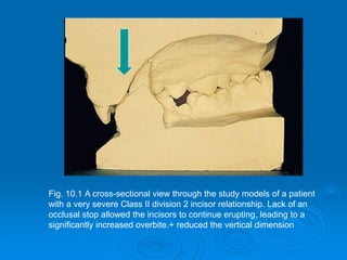 Fig. 10.1 A cross-sectional view through the study models of a patient
with a very severe Class II division 2 incisor relationship. Lack of an
occlusal stop allowed the incisors to continue erupting, leading to a
significantly increased overbite.+ reduced the vertical dimension
 