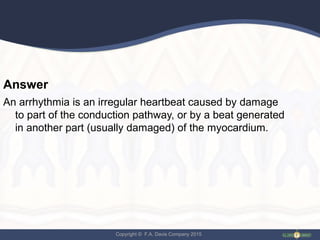Copyright © F.A. Davis Company 2015
Answer
An arrhythmia is an irregular heartbeat caused by damage
to part of the conduction pathway, or by a beat generated
in another part (usually damaged) of the myocardium.
 