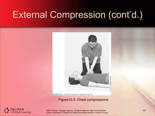 ©2013 Delmar, Cengage Learning. All Rights Reserved. May not be scanned,
copied, duplicated, or posted to a publicly accessible website, in whole or in part.
External Compression (cont’d.)
Figure12-3: Chest compressions
17
 