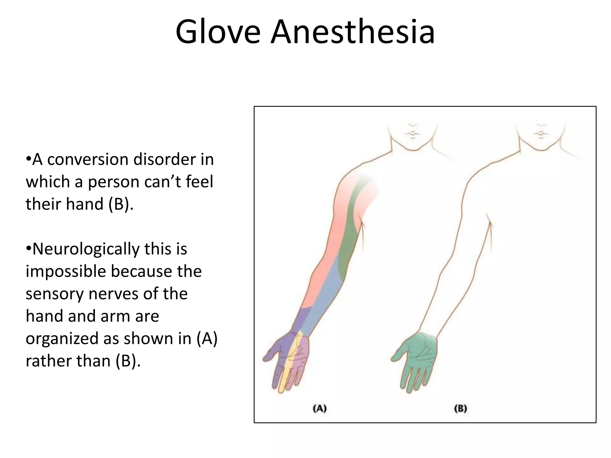 Glove Anesthesia
•A conversion disorder in
which a person can’t feel
their hand (B).
•Neurologically this is
impossible because the
sensory nerves of the
hand and arm are
organized as shown in (A)
rather than (B).
 