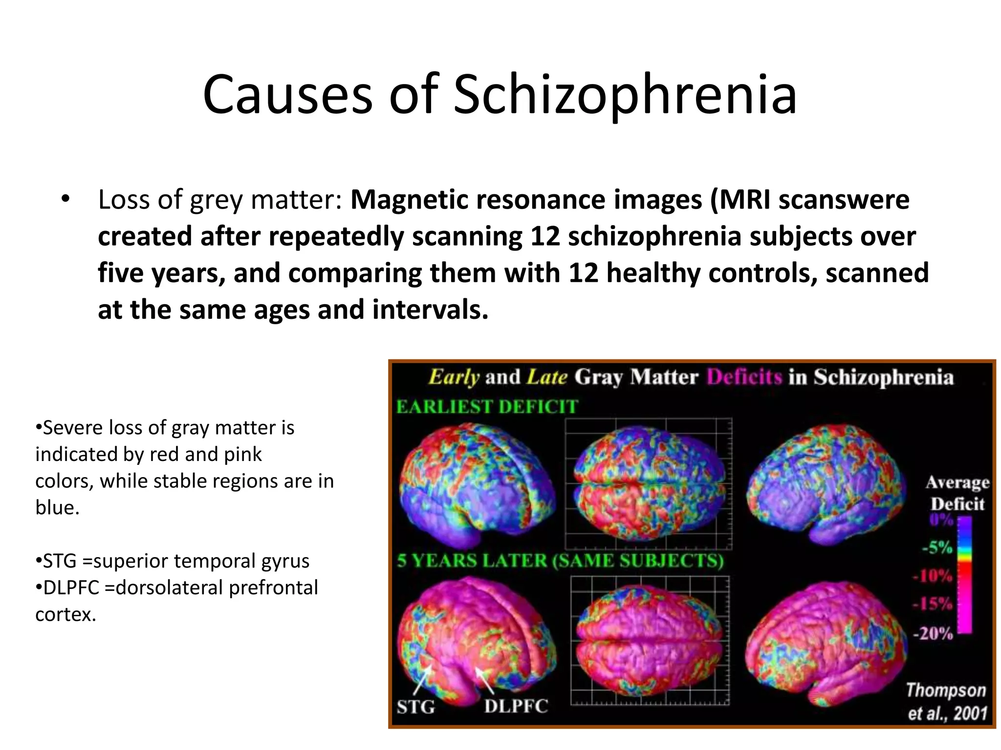 Causes of Schizophrenia
• Loss of grey matter: Magnetic resonance images (MRI scanswere
created after repeatedly scanning 12 schizophrenia subjects over
five years, and comparing them with 12 healthy controls, scanned
at the same ages and intervals.
•Severe loss of gray matter is
indicated by red and pink
colors, while stable regions are in
blue.
•STG =superior temporal gyrus
•DLPFC =dorsolateral prefrontal
cortex.
 