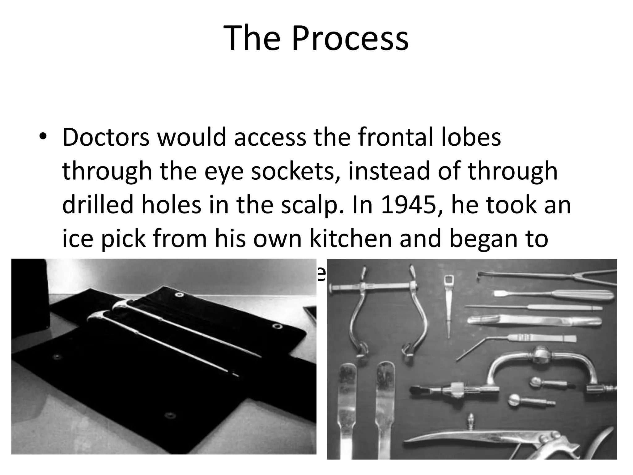 The Process
• Doctors would access the frontal lobes
through the eye sockets, instead of through
drilled holes in the scalp. In 1945, he took an
ice pick from his own kitchen and began to
test the new surgical technique on cadavers.
 