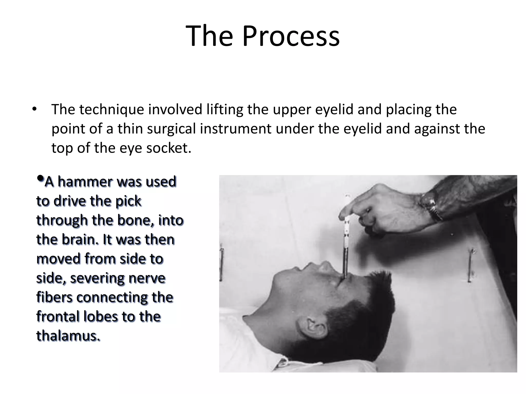 The Process
• The technique involved lifting the upper eyelid and placing the
point of a thin surgical instrument under the eyelid and against the
top of the eye socket.
•A hammer was used
to drive the pick
through the bone, into
the brain. It was then
moved from side to
side, severing nerve
fibers connecting the
frontal lobes to the
thalamus.
 