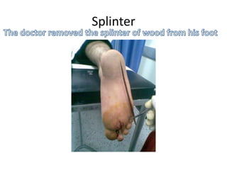 SplinterThe doctor removed the splinter of wood from his foot