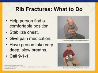 Supporting Rib Injury Ch13 presentation chest_abdominal_pelvic_injuries | PPTX
