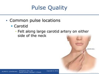 Copyright © 2016, 2012, 2009 by Pearson Education, Inc.
All Rights Reserved
Emergency Care, 13e
Daniel Limmer | Michael F. O'Keefe
Pulse Quality
• Common pulse locations
 Carotid
• Felt along large carotid artery on either
side of the neck
continued on next slide
 