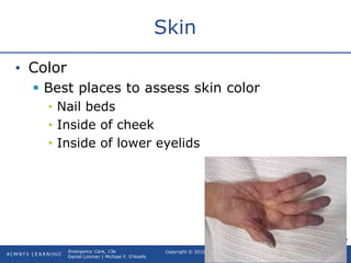 Copyright © 2016, 2012, 2009 by Pearson Education, Inc.
All Rights Reserved
Emergency Care, 13e
Daniel Limmer | Michael F. O'Keefe
Skin
• Color
 Best places to assess skin color
• Nail beds
• Inside of cheek
• Inside of lower eyelids
continued on next slide
 